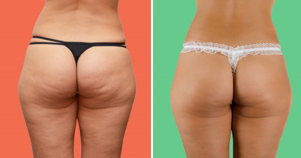 ¡Un solo ingrediente será suficiente para que te olvides de la celulitis y las estrías!