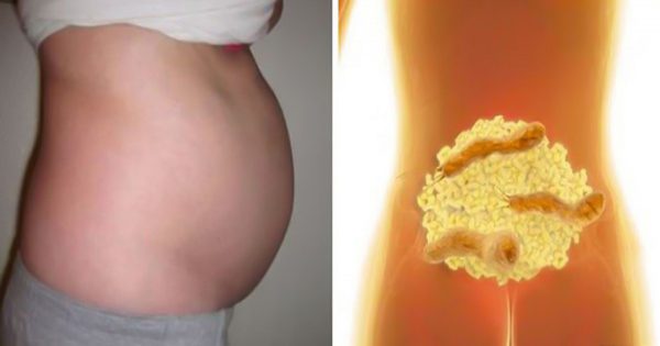 ¿Has notado una hinchazón en tu vientre? ¡Podría tratarse de una infección bacteriana!