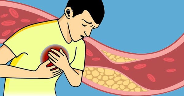 Como bajar el colesterol