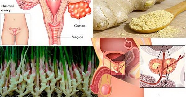 Jengibre: el arma perfecta contra el cáncer de colon, ovarios y próstata. ¡Mejor que la Quimioterapia!