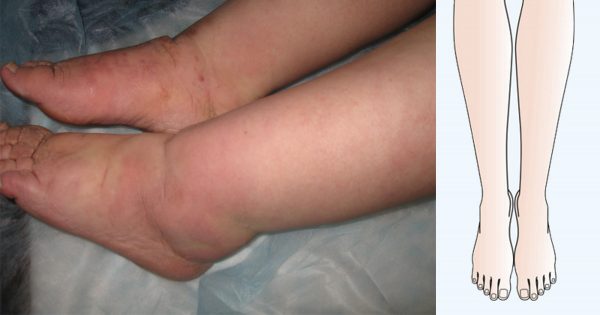 Si tus pies, de tan hinchados que están, se resisten a entrar en tus zapatos… ¡Prueba ESTO, y verás!