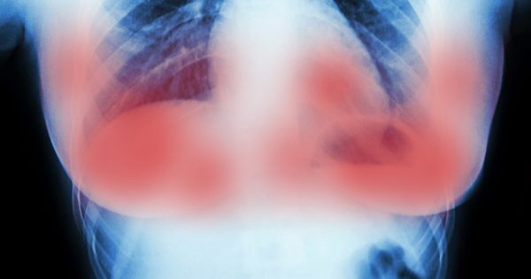 Desde Manchester nos llega una noticia esperanzadora: ¡El cáncer de mama se puede curar en 11 días!