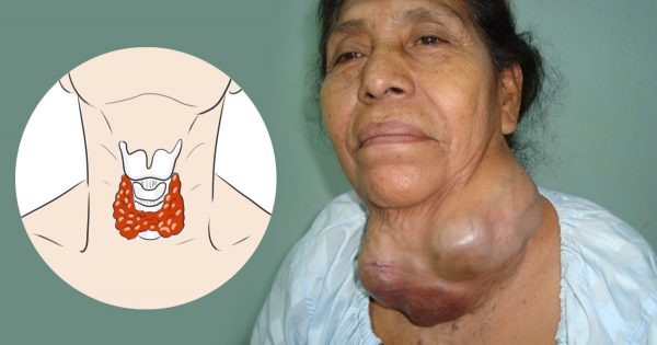 Una cura alternativa para la tiroides: ¡Secreto que los médicos se empeñan en esconder!
