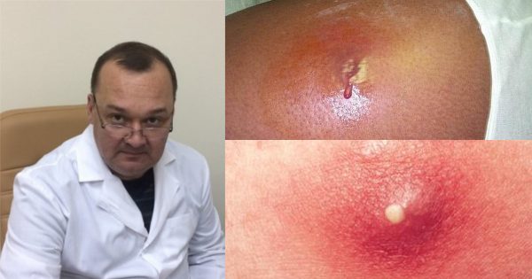 Este remedio te brindará una ayuda inmediata contra abscesos y forúnculos.