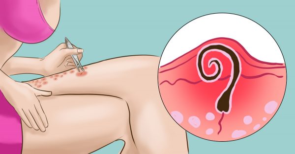 SOS de la depilación: 6 excelentes recomendaciones para eliminar los vellos encarnados.