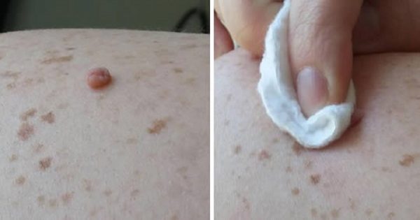 ¡Deshazte de las verrugas en tan sólo 24 horas! Este remedio natural te ayudará…