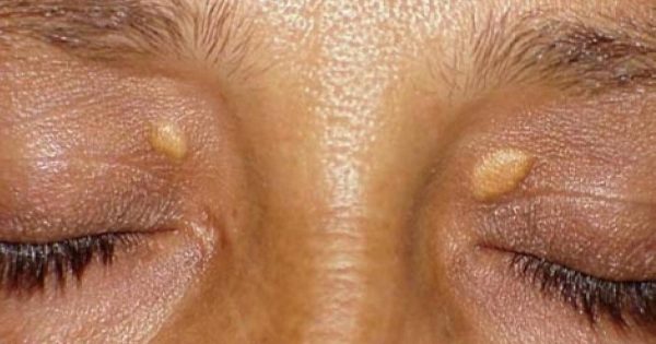 ¡Ya no más fibromas y las verrugas! Este es el camino más corto a la piel sana y hermosa…