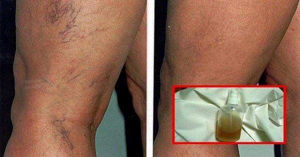 Bálsamo a lo natural: ¡La mejor manera de quitar la malla vascular y restaurar la belleza de la piel!