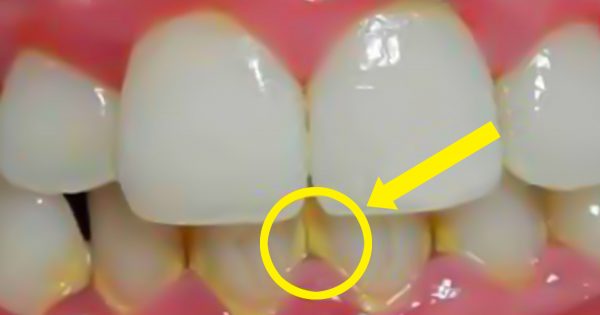¡Con este remedio las placas de los dientes desaparecerán! Cancelé la visita al dentista…