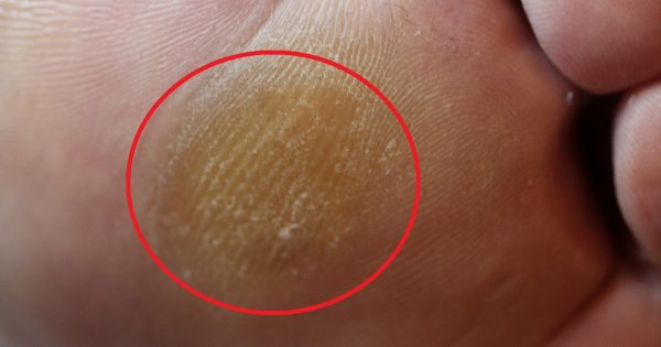 7 herramientas para la eliminación de los callos. ¡El tratamiento en casa con un buen resultado!