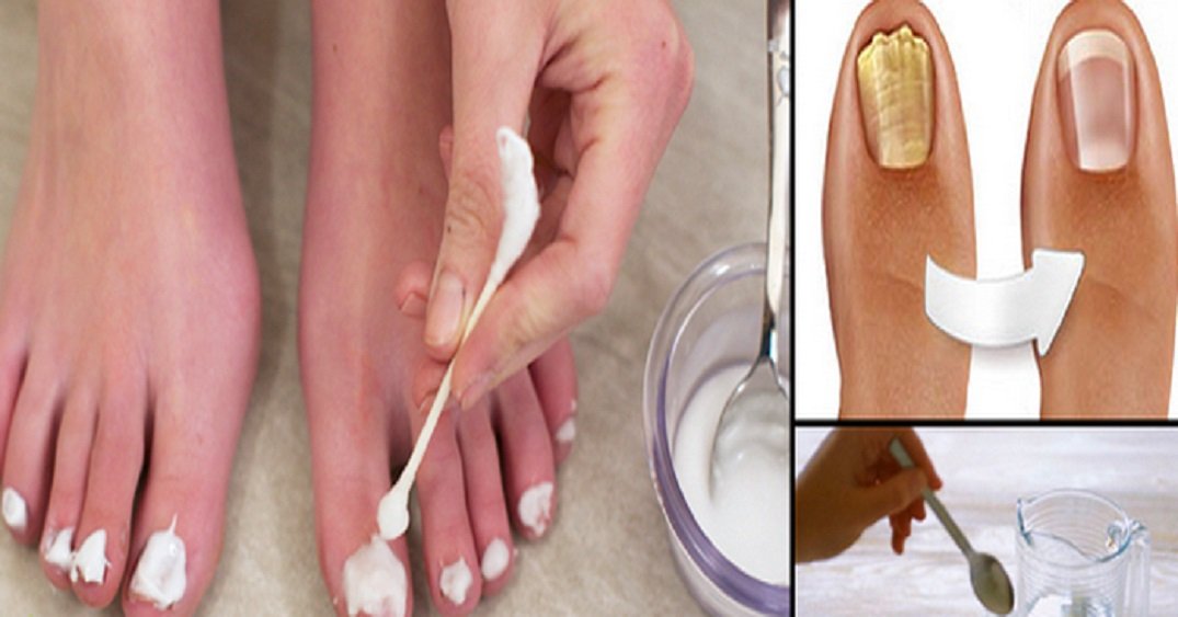 Que medicina es eficaz contra el hongo de las uñas