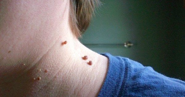 Cómo eliminar los papilomas en la piel en casa: ¡esta herramienta rompe todos los récords de eficiencia! Cómo eliminar los papilomas en la piel en casa: ¡esta herramienta rompe todos los récords de eficiencia!