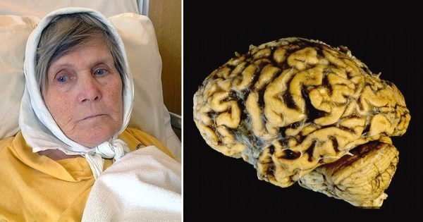 ¡La enfermedad de Alzheimer se puede prevenir! Sólo 1 ejercicio por día, y tu memoria estará al 100%…