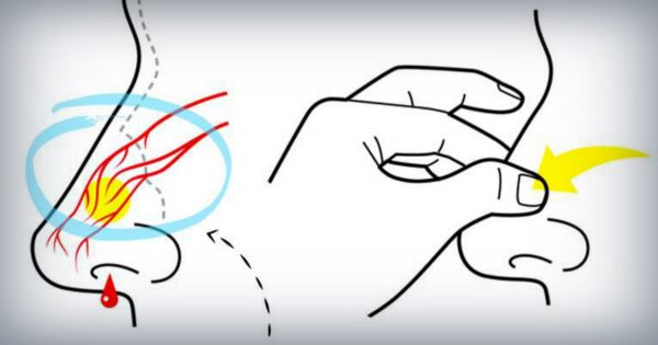 Consejo del día: El método correcto para detener el sangrado de la nariz.