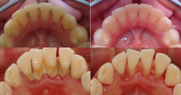 ¡Este remedio combate el sarro mejor que ultrasonido!