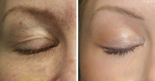 Cómo tensar los párpados caídos