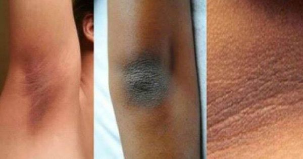 ¡La instrucción completa de cómo eliminar las manchas oscuras en el cuello, los codos, las rodillas y la zona de las axilas!