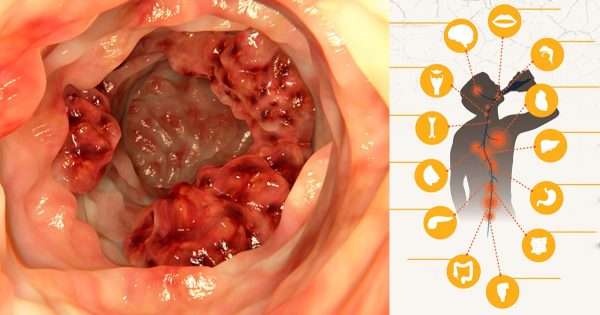 5 efectos peligrosos del consumo de alcohol: ¡Muchos ni se imaginan esto!