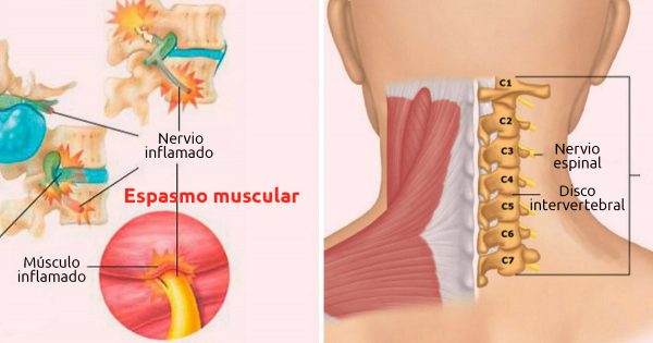 Aprende a relajar las contracciones musculares del cuello y la espalda: ¡Di adiós a los calambres
