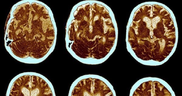 ¡La enfermedad de Alzheimer puede ser prevenida! Con estos ejercicios, tu memoria estará a salvo…