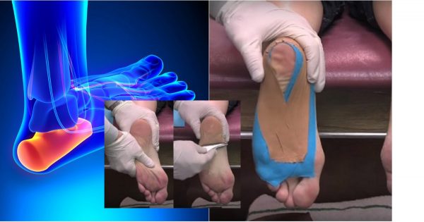 Ella no prestaba atención al dolor en el talón, y resultó ser un espolón… ¡Trátalo inmediatamente!