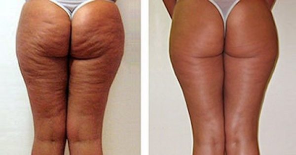 ¡Puedes darlo todo por esto! Quizás el remedio más asequible para la celulitis. ¡Puedes darlo todo por esto! Quizás el remedio más asequible para la celulitis.