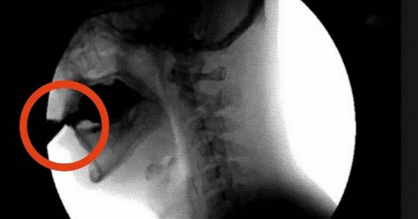 El daño de las bebidas carbonatadas.
