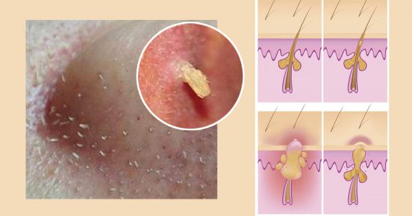 Después de usar esta máscara, no vas a reconocer tu piel. ¡Los puntos negros se habrán esfumado, créeme!