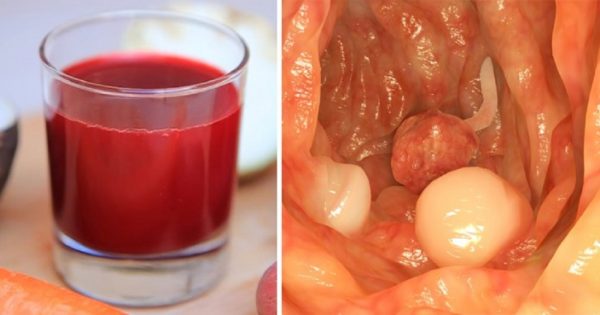 ¡Bebida de médico austríaco Rudolf Breuss ha sanado a unos 45 000 pacientes con cáncer!