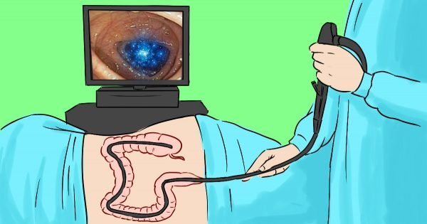 Si el doctor insiste en una colonoscopía, dígale que… ¡Desacreditamos el mito!