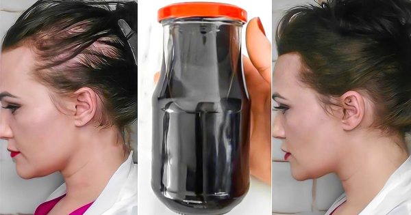 Con el método de una peluquera japonesa, a mi esposa le creció cabello nuevo. Su cabeza despoblada ya no brilla al sol. Con el método de una peluquera japonesa, a mi esposa le creció cabello nuevo. Su cabeza despoblada ya no brilla al sol.