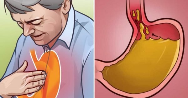 Remedio casero para la acidez de estómago