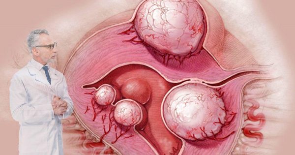 Si te diagnosticaron un quiste o fibroma… ¡Bebe este remedio natural, y verás!