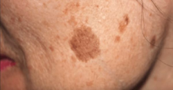 ¿Manchas de la edad, y no sabes qué hacer? ¡Basta de buscar! Este único ingrediente es la solución perfecta…