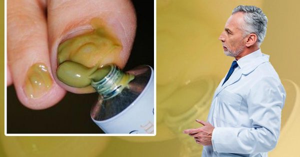 ¡Conozcan la solución perfecta para combatir los hongos en las uñas!