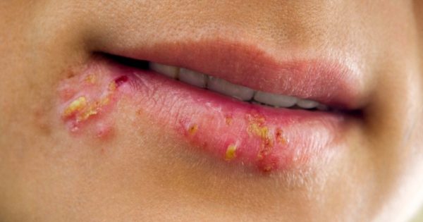 ¡7 técnicas populares que te ayudarán a deshacerte del herpes en el trascurso de un día!
