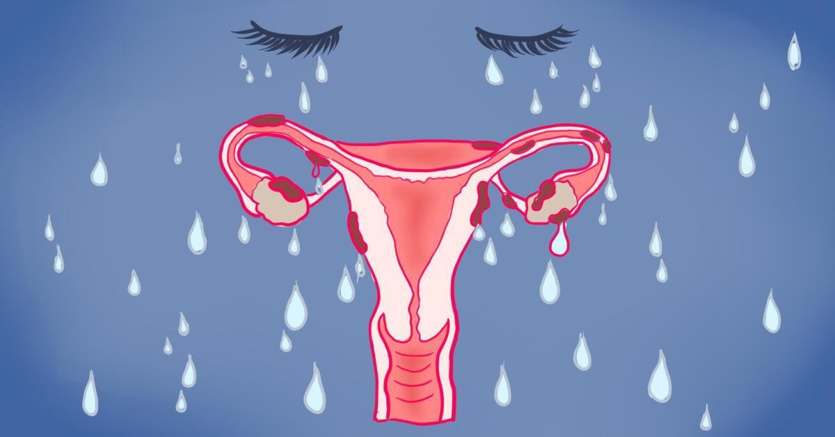 Endometriosis remedios caseros