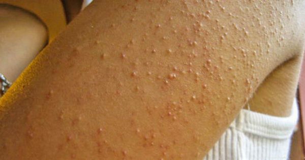 Ella no tenía idea del por qué de las erupciones en sus manos… Síntomas de enfermedad grave.