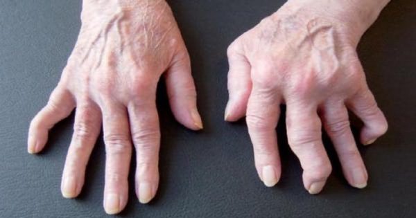 Este producto milagroso ayudó a erradicar el dolor de la artritis de una vez por todas. ¡Me siento aliviado!